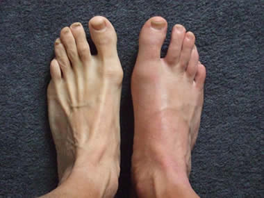 comment soigner goutte pied
